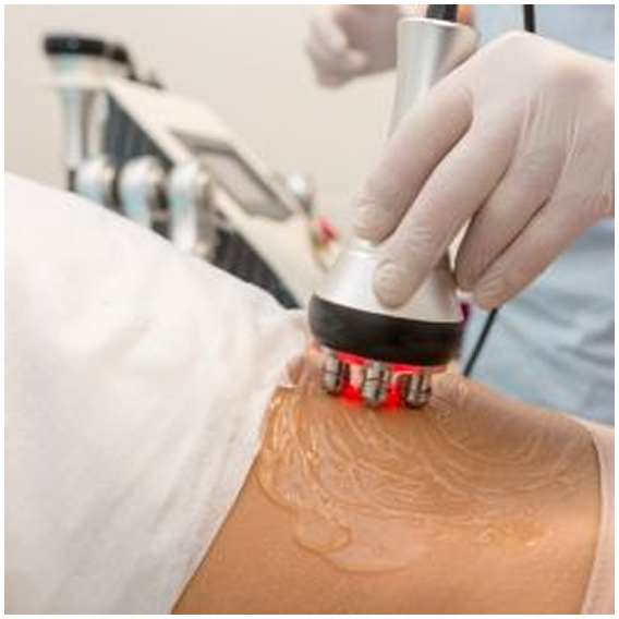 Radiofrequency ablation